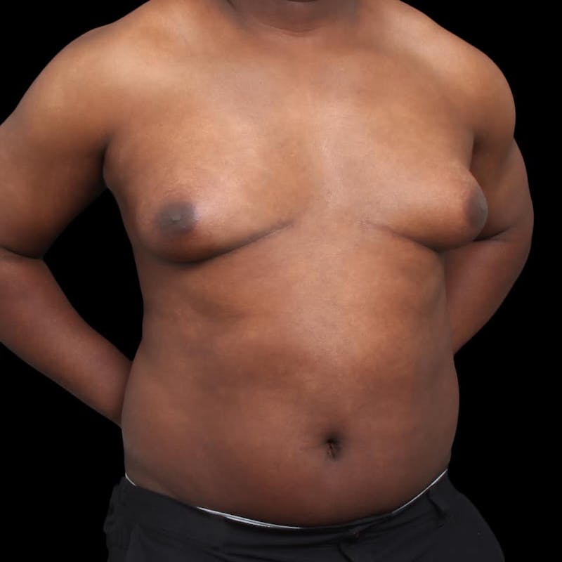 Gynecomastia Before & After Gallery - Patient 175963 - Image 7