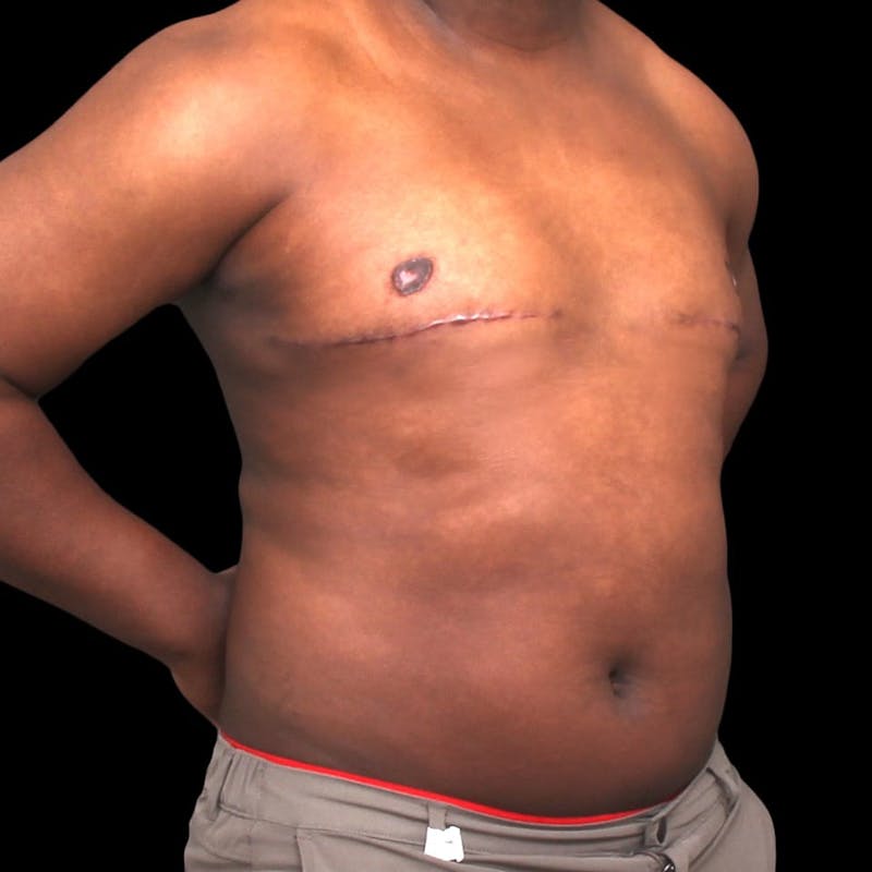 Gynecomastia Before & After Gallery - Patient 175963 - Image 8