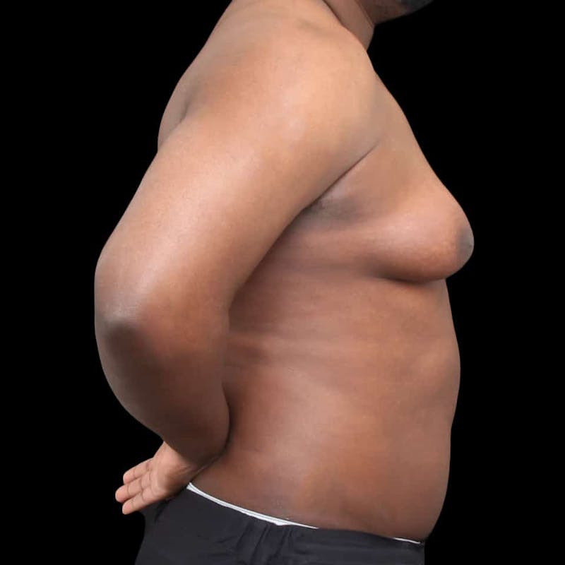 Gynecomastia Before & After Gallery - Patient 175963 - Image 9