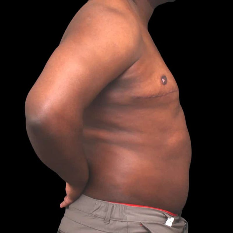 Gynecomastia Before & After Gallery - Patient 175963 - Image 10