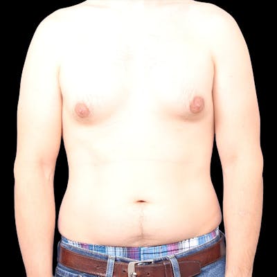Gynecomastia Before & After Gallery - Patient 376601 - Image 1