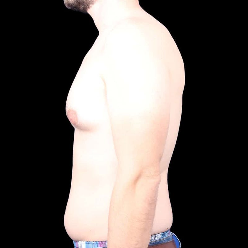 Gynecomastia Before & After Gallery - Patient 175963 - Image 13