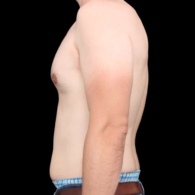 Gynecomastia Before & After Gallery - Patient 175963 - Image 14