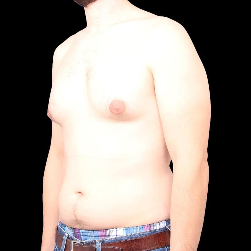 Gynecomastia Before & After Gallery - Patient 175963 - Image 15