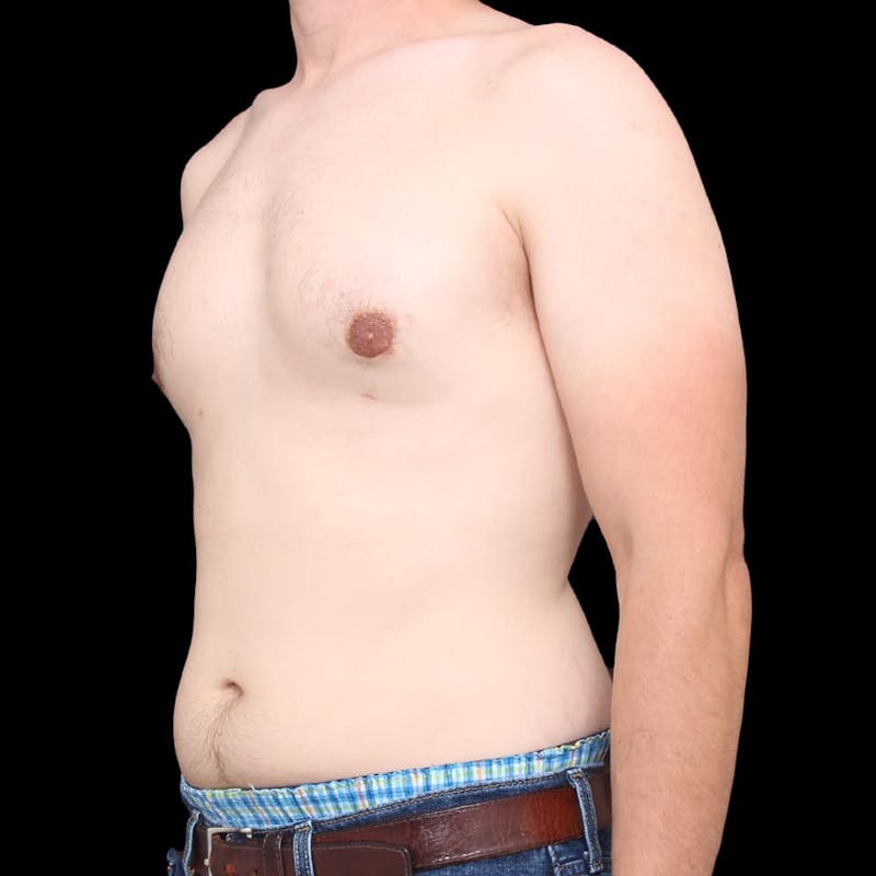 Gynecomastia Before & After Gallery - Patient 175963 - Image 16