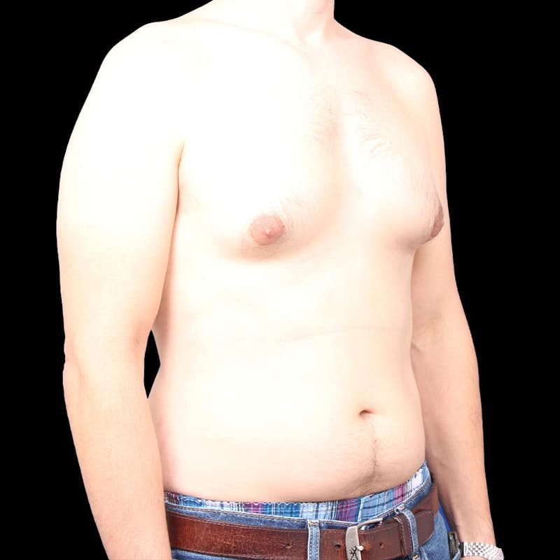 Gynecomastia Before & After Gallery - Patient 175963 - Image 17