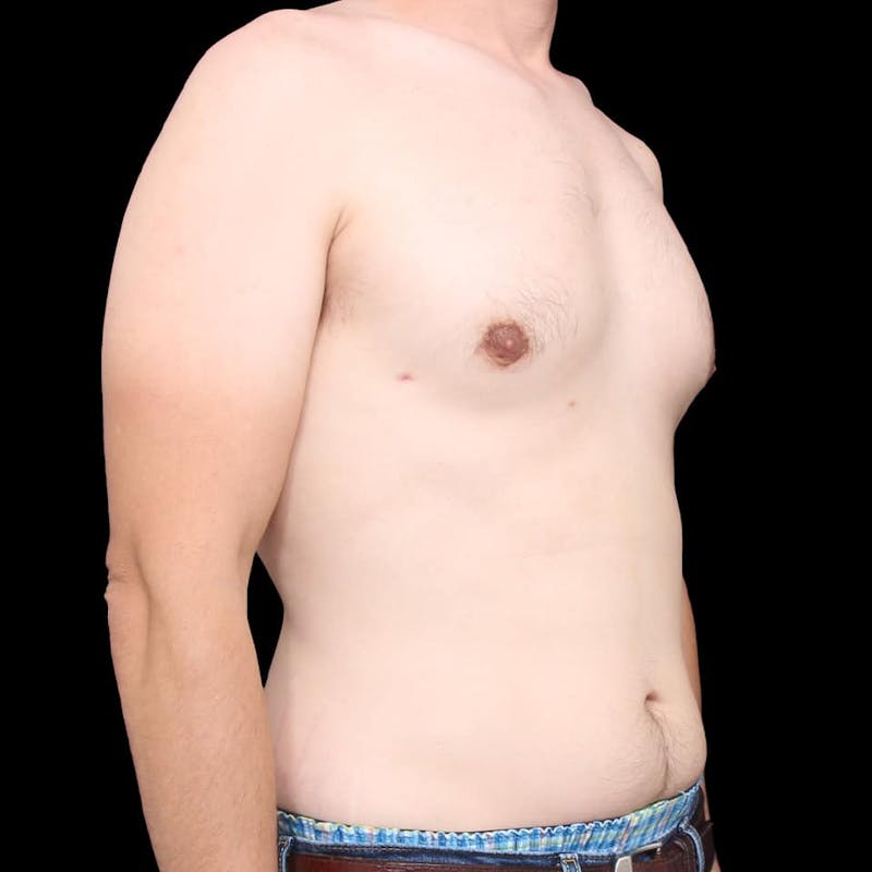 Gynecomastia Before & After Gallery - Patient 175963 - Image 18