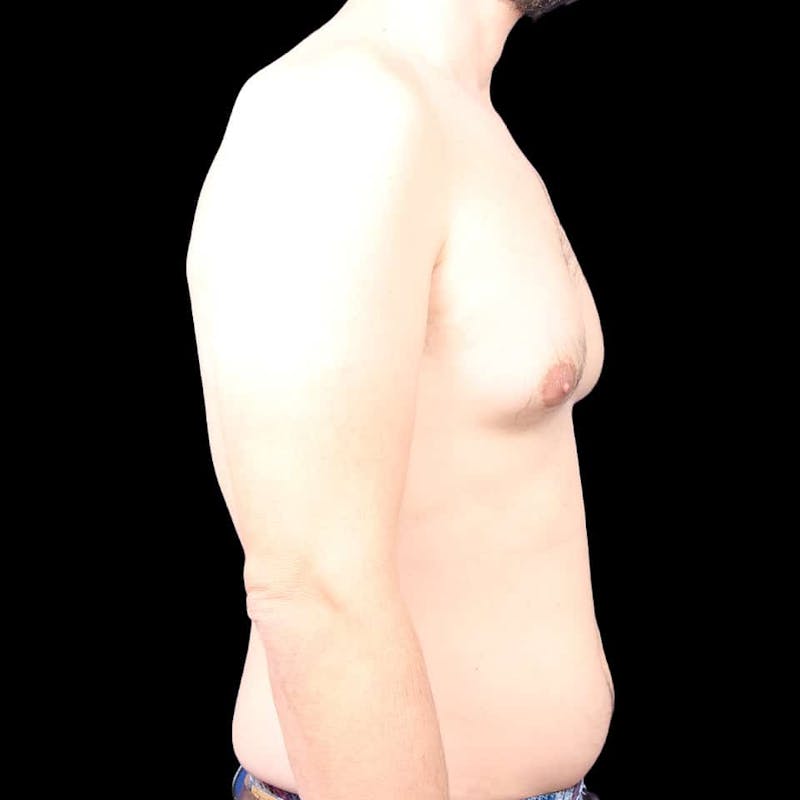 Gynecomastia Before & After Gallery - Patient 175963 - Image 19