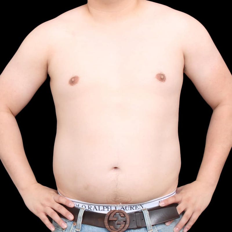 Gynecomastia Before & After Gallery - Patient 175963 - Image 21