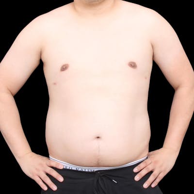 Gynecomastia Before & After Gallery - Patient 276647 - Image 2