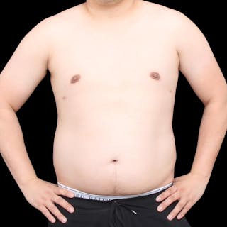 Gynecomastia Before & After Gallery - Patient 175963 - Image 22