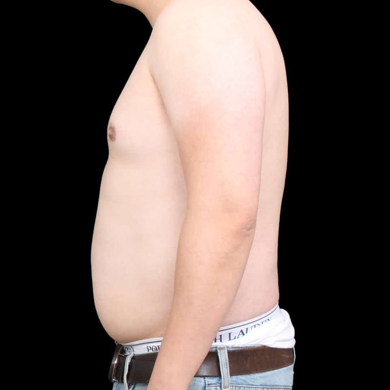 Gynecomastia Before & After Gallery - Patient 175963 - Image 23