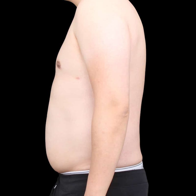 Gynecomastia Before & After Gallery - Patient 175963 - Image 24