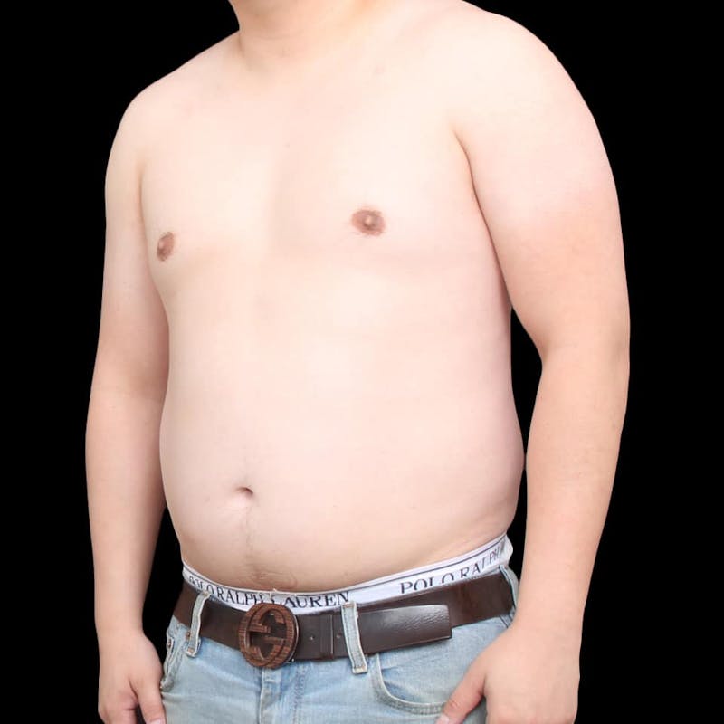 Gynecomastia Before & After Gallery - Patient 175963 - Image 25
