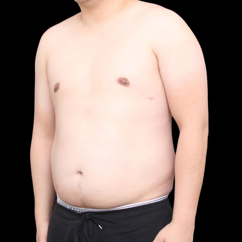 Gynecomastia Before & After Gallery - Patient 175963 - Image 26