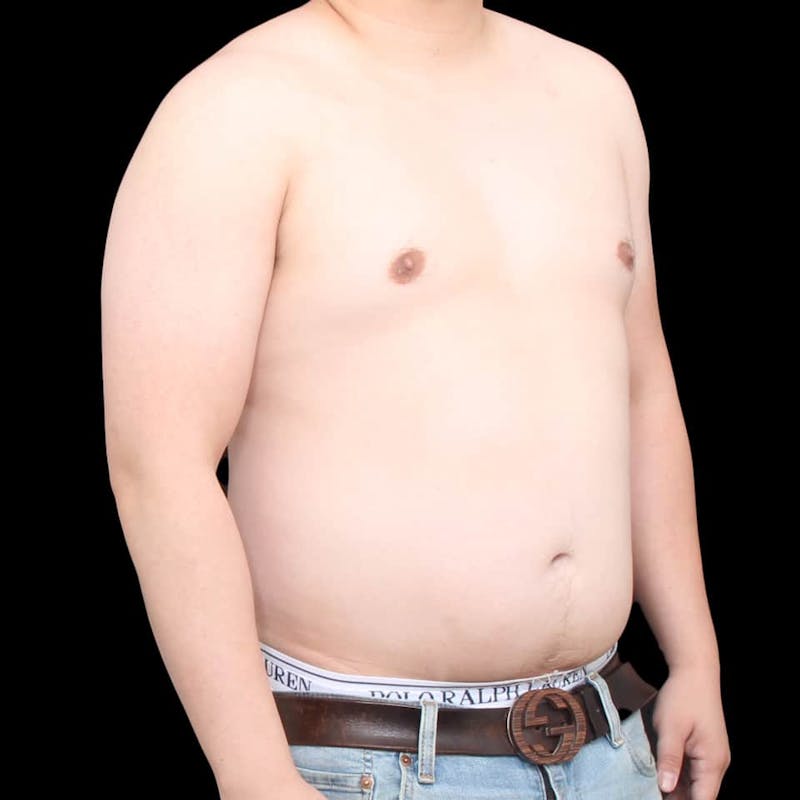 Gynecomastia Before & After Gallery - Patient 175963 - Image 27