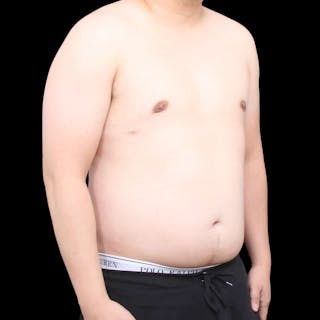 Gynecomastia Before & After Gallery - Patient 175963 - Image 28