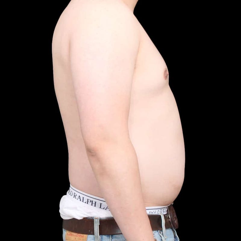 Gynecomastia Before & After Gallery - Patient 175963 - Image 29