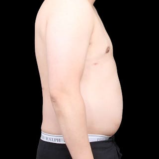 Gynecomastia Before & After Gallery - Patient 175963 - Image 30
