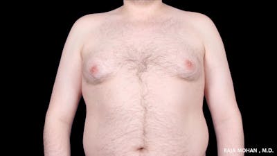 Gynecomastia Before & After Gallery - Patient 316946 - Image 1