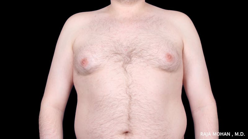 Gynecomastia Before & After Gallery - Patient 175963 - Image 31