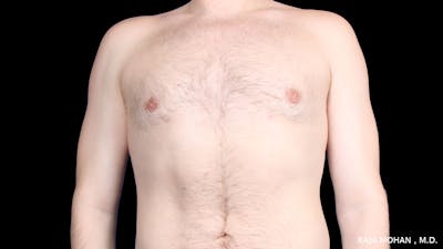 Gynecomastia Before & After Gallery - Patient 316946 - Image 2
