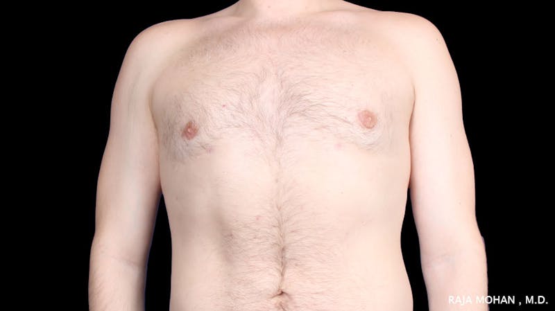 Gynecomastia Before & After Gallery - Patient 175963 - Image 32
