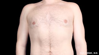 Gynecomastia Before & After Gallery - Patient 175963 - Image 32