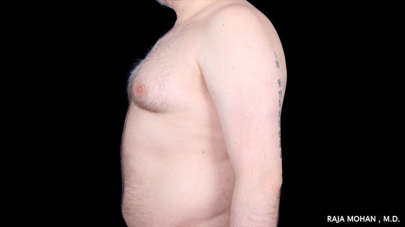 Gynecomastia Before & After Gallery - Patient 175963 - Image 33