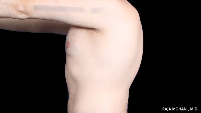 Gynecomastia Before & After Gallery - Patient 175963 - Image 34