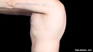 Gynecomastia Before & After Gallery - Patient 175963 - Image 34
