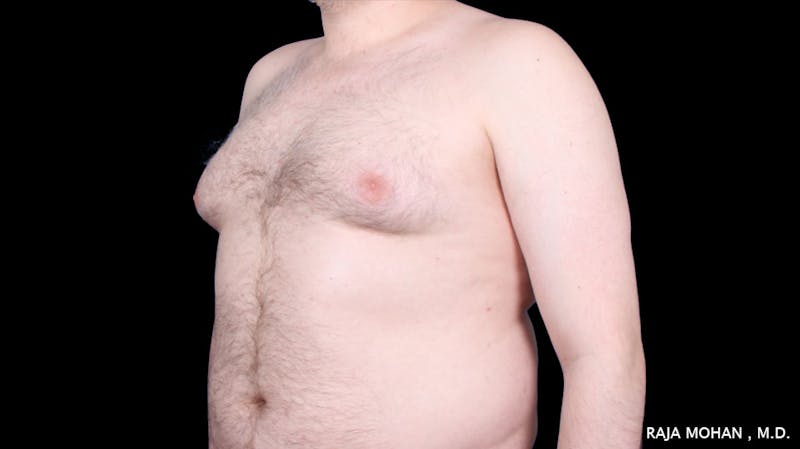 Gynecomastia Before & After Gallery - Patient 175963 - Image 35