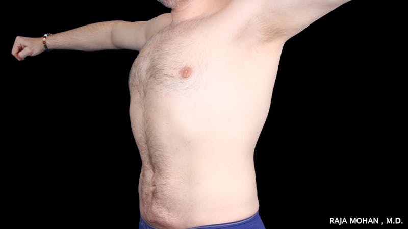 Gynecomastia Before & After Gallery - Patient 175963 - Image 36