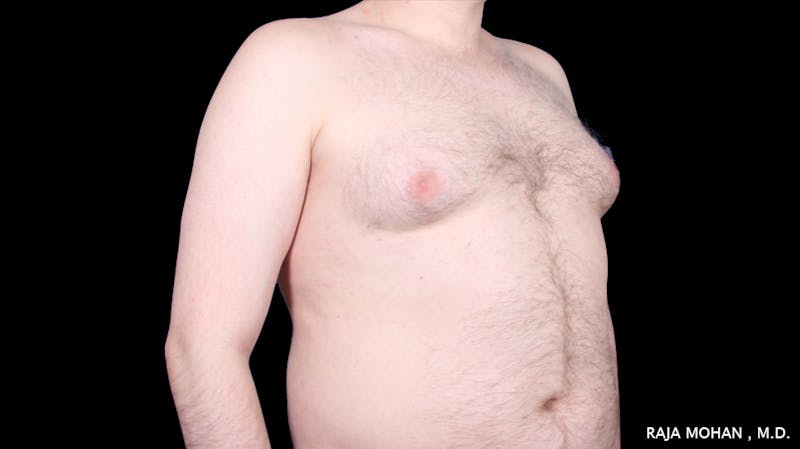 Gynecomastia Before & After Gallery - Patient 175963 - Image 37