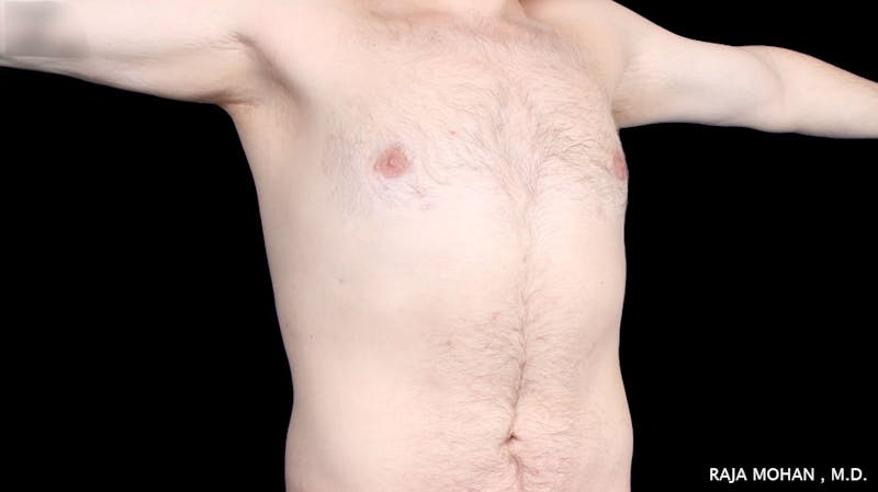 Gynecomastia Before & After Gallery - Patient 175963 - Image 38