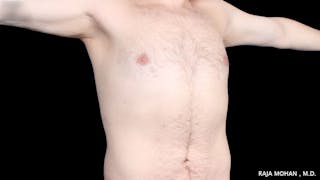 Gynecomastia Before & After Gallery - Patient 175963 - Image 38