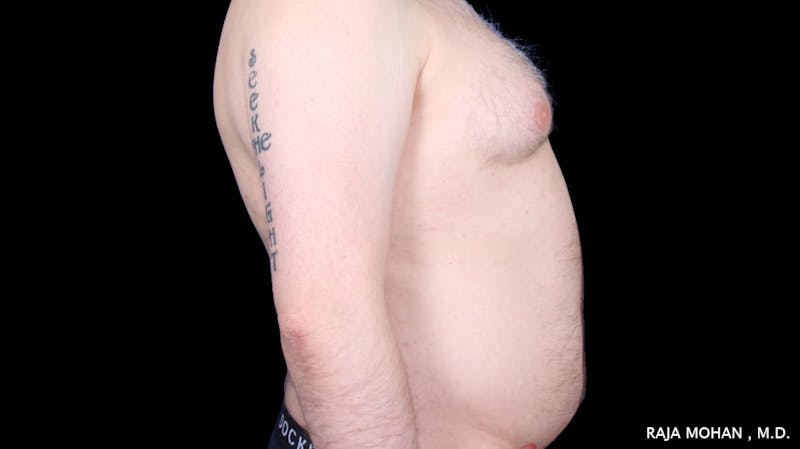 Gynecomastia Before & After Gallery - Patient 175963 - Image 39
