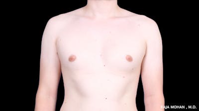 Gynecomastia Before & After Gallery - Patient 272835 - Image 1