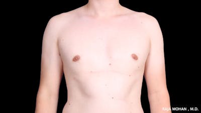 Gynecomastia Before & After Gallery - Patient 272835 - Image 2