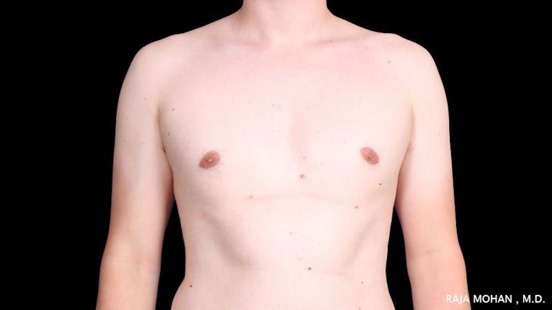 Gynecomastia Before & After Gallery - Patient 272835 - Image 2