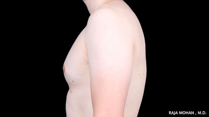 Gynecomastia Before & After Gallery - Patient 272835 - Image 3