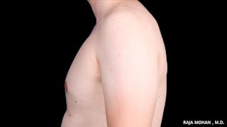 Gynecomastia Before & After Gallery - Patient 272835 - Image 4