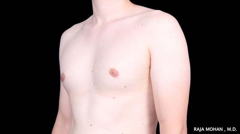 Gynecomastia Before & After Gallery - Patient 272835 - Image 5