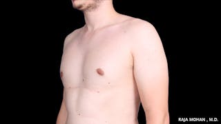 Gynecomastia Before & After Gallery - Patient 272835 - Image 6