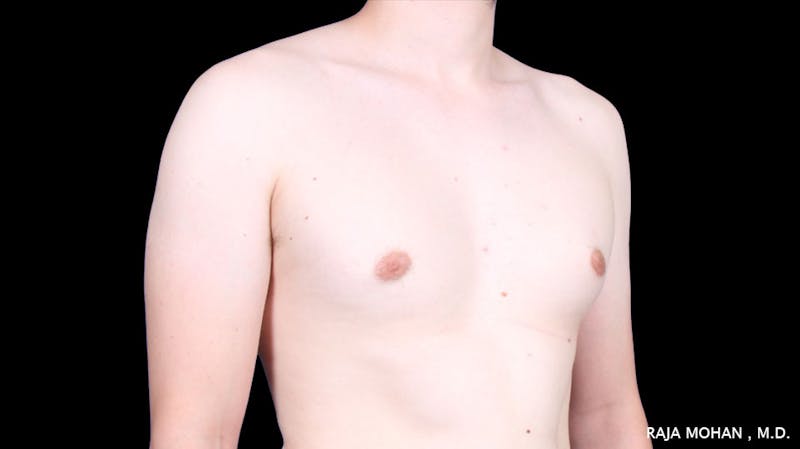 Gynecomastia Before & After Gallery - Patient 272835 - Image 7