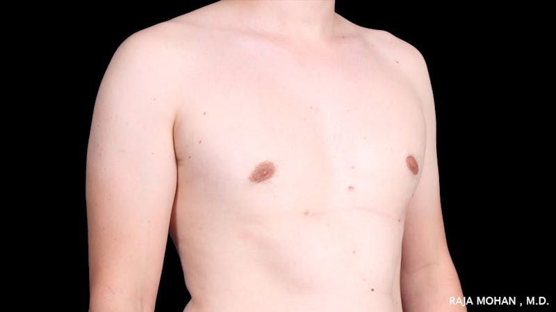Gynecomastia Before & After Gallery - Patient 272835 - Image 8
