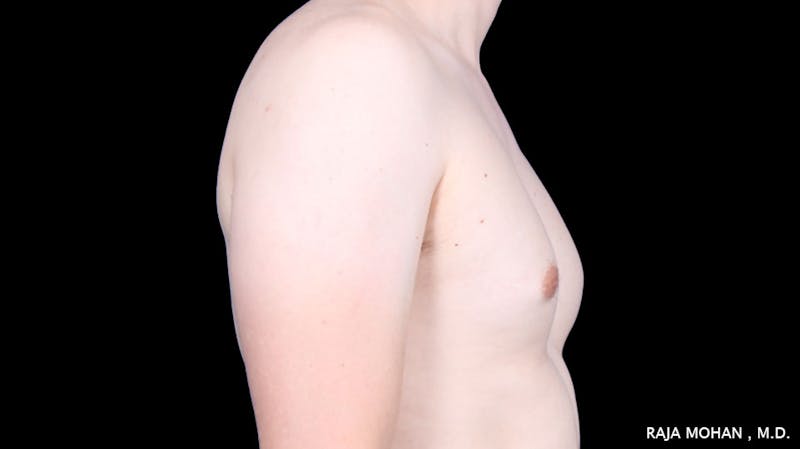 Gynecomastia Before & After Gallery - Patient 272835 - Image 9