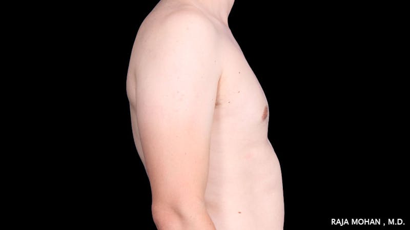 Gynecomastia Before & After Gallery - Patient 272835 - Image 10