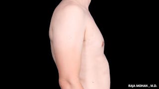 Gynecomastia Before & After Gallery - Patient 272835 - Image 10