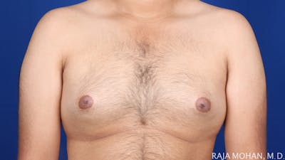 Gynecomastia Before & After Gallery - Patient 616616 - Image 1